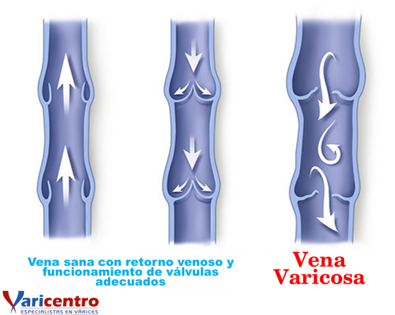¿ QUE SON LAS VARICES ?