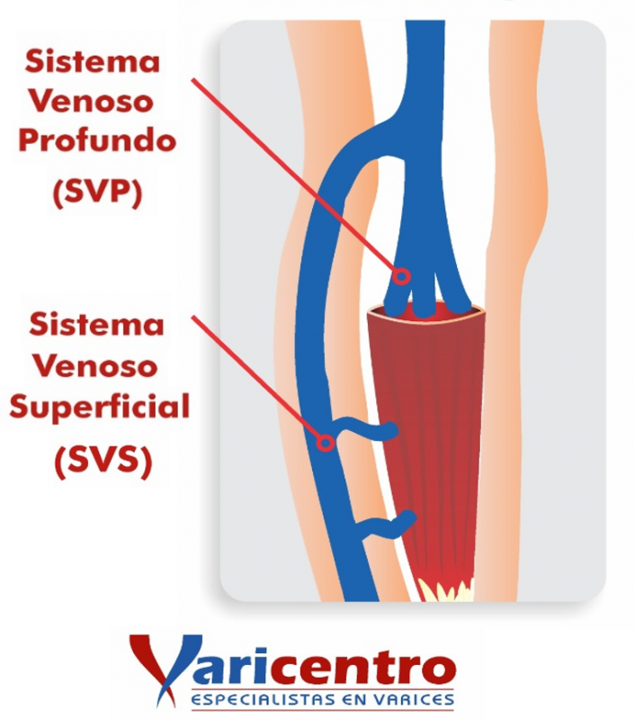 VARICES INTERNAS O PROFUNDAS