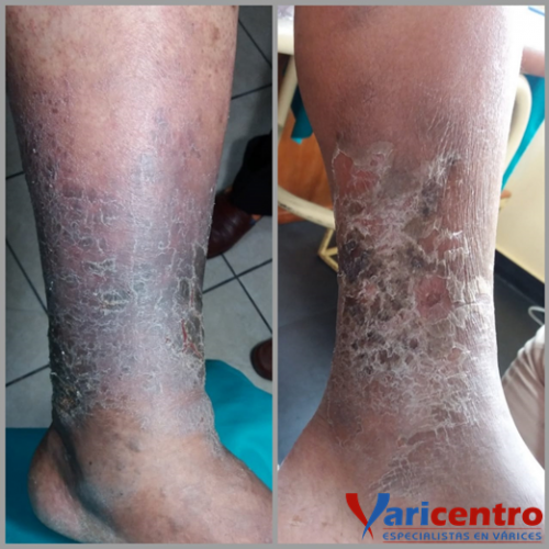 Eczema varicoso