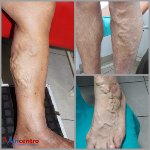 Varices tronculares o troncales