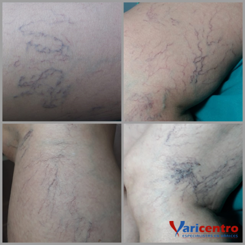 Telangiectasias o Arañas vasculares