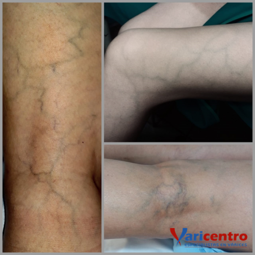 Varices reticulares