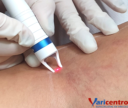 Laser vascular diodo 980 nm